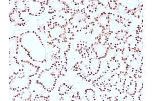 Formalin-fixed, paraffin-embedded human thyroid carcinoma stained with Cyclin D1 Mouse Monoclonal Antibody (CCND1/2593). (Cyclin D1 antibody)