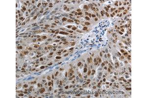 Immunohistochemistry of Human ovarian cancer using MCM3 Polyclonal Antibody at dilution of 1:30