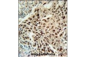 PRNIP Antibody (C-term) (ABIN651984 and ABIN2840482) immunohistochemistry analysis in formalin fixed and paraffin embedded human lung carcinoma followed by peroxidase conjugation of the secondary antibody and DAB staining. (ERI3 antibody  (C-Term))