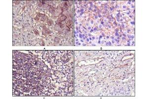Immunohistochemical analysis of paraffin-embedded human lung cancer (A), cholangiocarcinorna (B), lymph node (C) and esophagus (D) tissues using NT5E mouse mAb with DAB staining. (CD73 antibody)