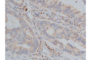 ABIN6268647 at 1/200 staining human lung cancer tissue sections by IHC-P. (TSC1 antibody  (C-Term))