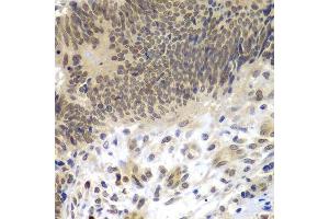 Immunohistochemistry of paraffin-embedded human colon carcinoma using CEBPG antibody. (CEBPG antibody  (AA 1-150))