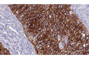 ABIN6268995 at 1/100 staining Human urothelial cancer tissue by IHC-P.