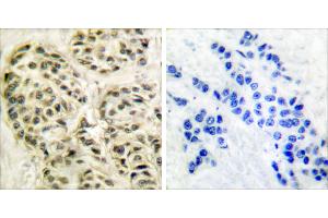 Peptide - +Immunohistochemical analysis of paraffin-embedded human breast carcinoma tissue using Cyclin-L1 antibody (#C0295). (Cyclin L1 antibody)
