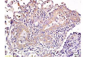 Formalin-fixed and paraffin embedded human gastric cancer labeled with Anti CD1a/Cortical thymocyte antigen CD1A Polyclonal Antibody, Unconjugated  at 1:300 followed by conjugation to the secondary antibody and DAB staining (CD1a antibody  (AA 151-250))