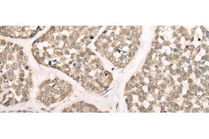 Immunohistochemistry of paraffin-embedded Human esophagus cancer tissue using CAPN15 Polyclonal Antibody at dilution of 1:50(x200) (Calpain 15/SOLH antibody)