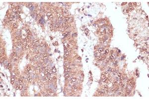 Immunohistochemistry of paraffin-embedded Human colon carcinoma using RAD50 Polyclonal Antibody at dilution of 1:100 (40x lens). (RAD50 antibody)