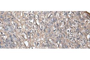 Immunohistochemistry of paraffin-embedded Human lung cancer tissue using NDUFB5 Polyclonal Antibody at dilution of 1:45(x200)