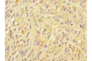 Immunohistochemistry of paraffin-embedded human melanoma using ABIN7174484 at dilution of 1:100 (UBE2S antibody  (AA 1-222))