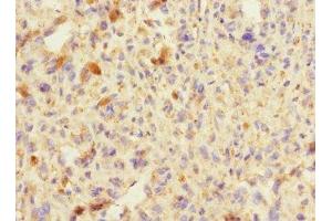Immunohistochemistry of paraffin-embedded human melanoma using ABIN7151292 at dilution of 1:100 (TRIP12 antibody  (AA 1-240))