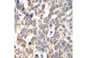 Immunohistochemistry of paraffin-embedded human esophageal cancer using PARN antibody at dilution of 1:100 (x40 lens). (PARN antibody)
