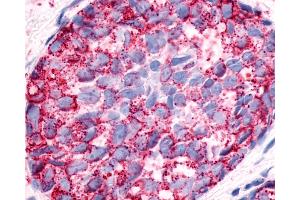 Anti-NPFFR1 / GPR147 antibody IHC of human Breast, Carcinoma. (NPFFR1 antibody  (Extracellular Domain))