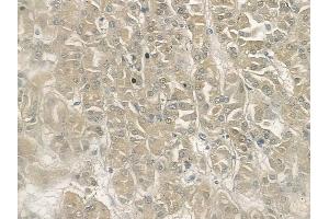 ABIN6262942 and ABIN6272945 at 1/100 staining human renal cell carcinoma by IHC-P.