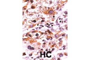 Formalin-fixed and paraffin-embedded human cancer tissue reacted with the primary antibody, which was peroxidase-conjugated to the secondary antibody, followed by AEC staining. (FGFR (pTyr766) antibody)