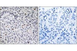 Immunohistochemistry analysis of paraffin-embedded human breast carcinoma tissue, using ZAP-70 (Ab-315) Antibody. (ZAP70 antibody  (AA 281-330))