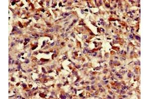 Immunohistochemistry of paraffin-embedded human melanoma using ABIN7155470 at dilution of 1:100 (ASH1L antibody  (AA 1906-2160))