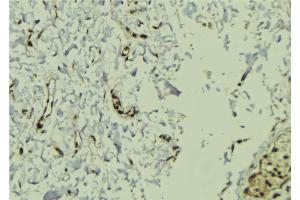 ABIN6272922 at 1/100 staining Human breast cancer tissue by IHC-P. (FERMT2 antibody  (C-Term))