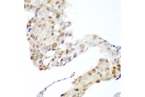 Immunohistochemistry of paraffin-embedded human lung cancer using CDK1 antibody. (CDK1 antibody)