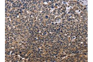 The image is immunohistochemistry of paraffin-embedded Human cervical cancer tissue using ABIN7129566(GADD45A Antibody) at dilution 1/30. (GADD45A antibody)