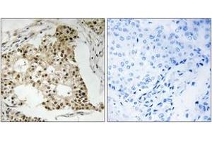 Immunohistochemistry analysis of paraffin-embedded human breast carcinoma, using Retinoic Acid Receptor alpha (Phospho-Ser77) Antibody. (Retinoic Acid Receptor alpha antibody  (pSer77))