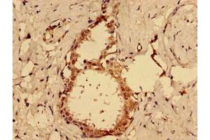Immunohistochemistry of paraffin-embedded human ovarian cancer using ABIN7164435 at dilution of 1:100 (MKRN2 antibody  (AA 29-170))