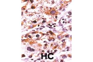 Formalin-fixed and paraffin-embedded human hepatocellular carcinoma tissue reacted with FGFR1 (phospho Y766) polyclonal antibody  which was peroxidase-conjugated to the secondary antibody followed by AEC staining.