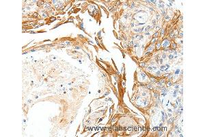 Immunohistochemistry of Human esophagus cancer using PLAT Polyclonal Antibody at dilution of 1:50 (PLAT antibody)