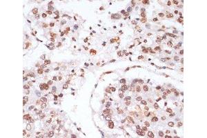 Immunohistochemistry of paraffin-embedded Human liver cancer using Phospho-Stat3(Y705) Polyclonal Antibody at dilution of 1:100 (40x lens). (STAT3 antibody  (pTyr705))