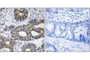 Immunohistochemistry analysis of paraffin-embedded human colon carcinoma tissue, using EIF1AY Antibody.