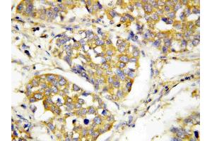 Anti-TLR4 antibody, IHC(P): Human Lung Cancer Tissue