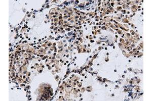 Immunohistochemical staining of paraffin-embedded Adenocarcinoma of Human breast tissue using anti-CBWD1 mouse monoclonal antibody. (CBWD1 antibody)