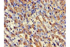 Immunohistochemistry of paraffin-embedded human liver cancer using ABIN7145083 at dilution of 1:100 (Aurora Kinase C antibody  (AA 12-143))