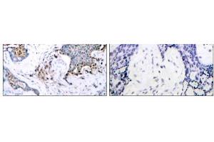 Immunohistochemical analysis of paraffin-embedded human breast carcinoma tissue using Estrogen Receptor-α (phospho-Ser118) antibody (E011072). (Estrogen Receptor alpha antibody  (pSer118))