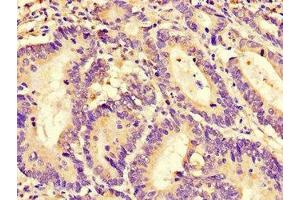 Immunohistochemistry of paraffin-embedded human colon cancer using ABIN7167611 at dilution of 1:100