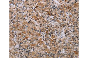 Immunohistochemistry of Human liver cancer using AATK Polyclonal Antibody at dilution of 1:45 (AATK antibody)