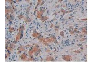 IHC-P analysis of Human Prostate Gland Cancer Tissue, with DAB staining. (Kallikrein 10 antibody  (AA 35-276))
