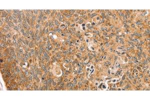 Immunohistochemistry of paraffin-embedded Human esophagus cancer using TRIM62 Polyclonal Antibody at dilution of 1:30 (TRIM62 antibody)