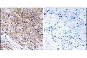 Immunohistochemistry analysis of paraffin-embedded human breast carcinoma tissue, using TRAPPC1 Antibody. (TRAPPC1 antibody  (AA 10-59))