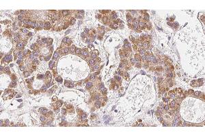 ABIN6279304 at 1/100 staining Human liver cancer tissue by IHC-P. (CLDN14 antibody  (C-Term))