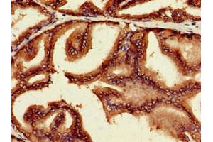 Immunohistochemistry of paraffin-embedded human prostate cancer using ABIN7160384 at dilution of 1:100 (c-MYC antibody  (AA 16-454))