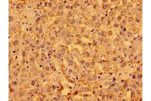 Immunohistochemistry of paraffin-embedded human liver cancer using ABIN7165807 at dilution of 1:100 (MENT (AA 24-197) antibody)