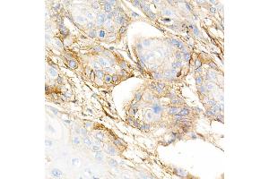 Immunohistochemistry of paraffin-embedded human esophageal cancer using Integrin-β1/CD29 Rabbit mAb (ABIN7267926) at dilution of 1:5000 (40x lens). (ITGB1 antibody)
