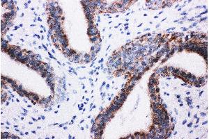 Anti-PI 3 Kinase p85 beta antibody, IHC(P) IHC(P): Human Mammary Cancer Tissue (PIK3R2 antibody  (Middle Region))