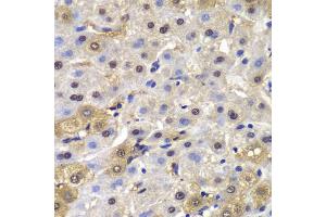 Immunohistochemistry of paraffin-embedded human liver cancer using MAD1L1 antibody (ABIN5970500) at dilution of 1/100 (40x lens). (MAD1L1 antibody)