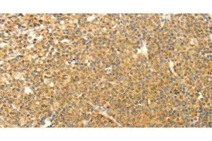 Immunohistochemistry of paraffin-embedded Human lymphoma using AARS2 Polyclonal Antibody at dilution of 1:40 (AARS2 antibody)
