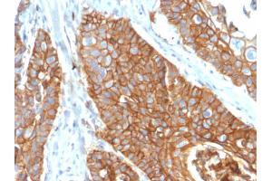 Formalin-fixed, paraffin-embedded human Cervical Carcinoma stained with CD9 Mouse Monoclonal Antibody (CD9/2343). (CD9 antibody)