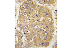 Formalin-fixed and paraffin-embedded human hepatocarcinoma tissue reacted with IGFBP3 Antibody (N-term) (ABIN391974 and ABIN2841768) , which was peroxidase-conjugated to the secondary antibody, followed by DAB staining. (IGFBP3 antibody  (N-Term))