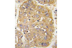 Formalin-fixed and paraffin-embedded human hepatocarcinoma tissue reacted with IGFBP3 Antibody (N-term) (ABIN391974 and ABIN2841768) , which was peroxidase-conjugated to the secondary antibody, followed by DAB staining.