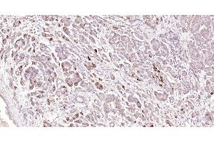 Paraformaldehyde-fixed, paraffin embedded Human pancreatic cancer; Antigen retrieval by boiling in sodium citrate buffer (pH6. (GLP-1 antibody  (AA 7-36))