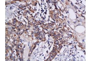 Formalin-fixed and paraffin embedded human colon carcinoma labeled with Anti-DAPK1 Polyclonal Antibody, Unconjugated  at 1:200 followed by conjugation to the secondary antibody and DAB staining (DAP Kinase 1 antibody  (AA 1331-1430))
